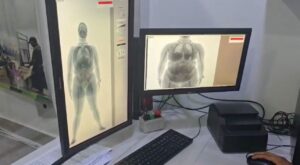 Radiografía confirma presencia de 31 cápsulas ingeridas para tráfico internacional.